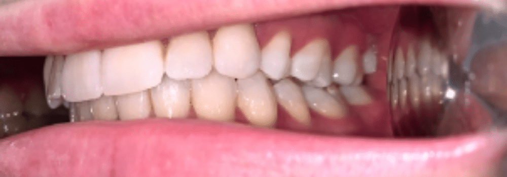 Photo of an intraoral orthodontic selfie
