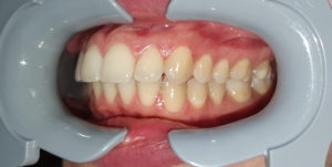good photo in dental monitoring taken with a cheek retractor tool