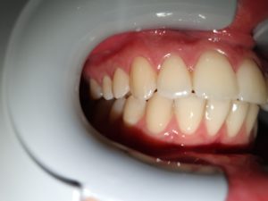 Photo taken too close in dental monitoring
