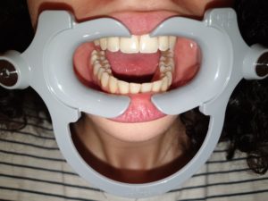 photo for dental monitoring for occlusal