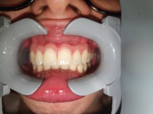 Photos for Dental Monitoring lips hiding teeth