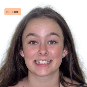 Grace's braces transformation