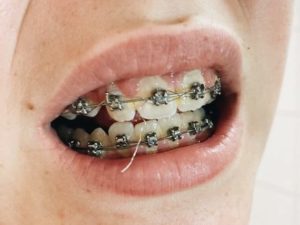 Wires used in braces treatment